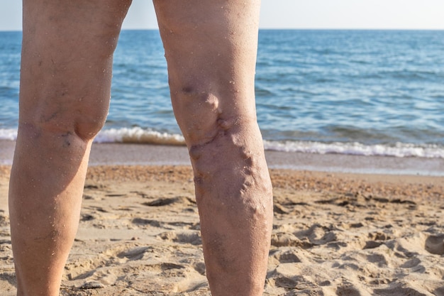 Schmerzende Beine der Frau mit hervortretenden Venen entlang der Rückseite des Unterschenkels. Krampfadern bei Frauen