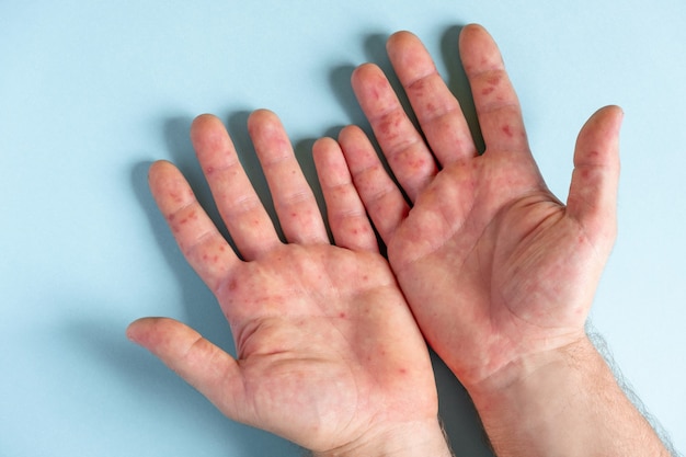 Schmerzhafter Hautausschlag rote Flecken Blasen an der Hand Nahaufnahme Allergieausschlag menschliche Hände mit Dermatitis