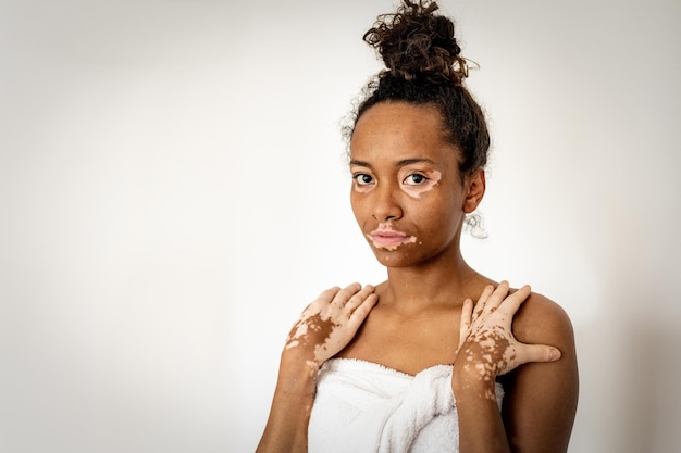 Schöne junge afrikanisch-amerikanische Frau mit Vitiligo, die mit Handtuch-Hautpflege- und genetischen Pigmentierungskonzepten posiert, lächelnde Menschen und körperpositives Konzept, weißer Hintergrund