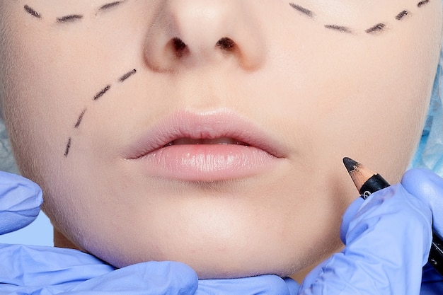 Schöne junge Frau mit Perforationslinien im Gesicht vor der Operation der plastischen Chirurgie