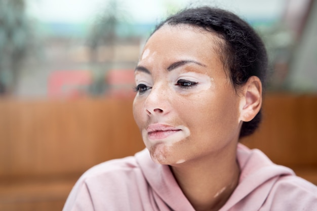 Schwarze afroamerikanische Frau mit Vitiligo-Pigmentation Hautproblem Indoor gekleidet rosa Hoodie Nahaufnahme Porträt nachdenkliche schwarze Frau, die darüber nachdenkt