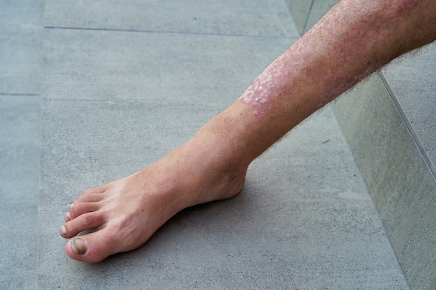 Foto schwere psoriasis am bein eines mannes nahaufnahme.