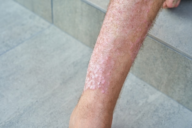 Schwere Psoriasis am Bein eines Mannes Nahaufnahme.