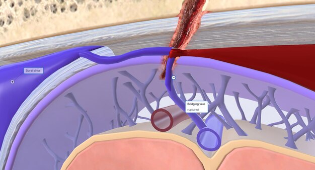 Foto si se produce un traumatismo craneoencefálico, el aumento de la tensión en las venas puente puede hacer que se desgarren. esto conduce a una hemorragia subdural.