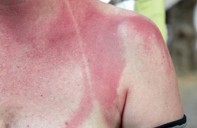 Signo de piel roja y traje de baño de una mujer que ha estado al sol en las calurosas horas de verano