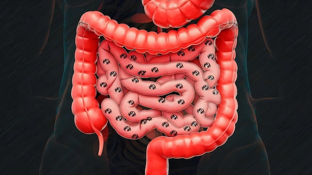 Síndrome do intestino irritável