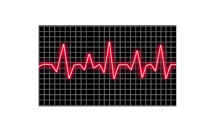 Foto síndrome do qt longo ecg 2o tipo ilustração 3d isolada com destaques brancos