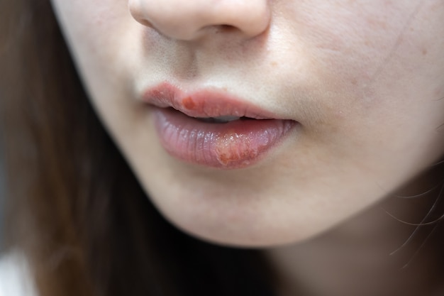 Síntoma de herpes en labios de mujer asiática