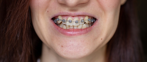 Foto sistema brasket en boca sonriente, dientes de fotografía macro, labios de primer plano, disparo macro, dentista.