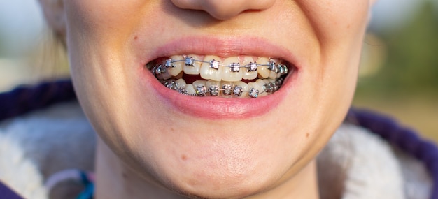 Sistema Brasket en boca sonriente, dientes de fotografía macro, labios de primer plano, disparo macro.