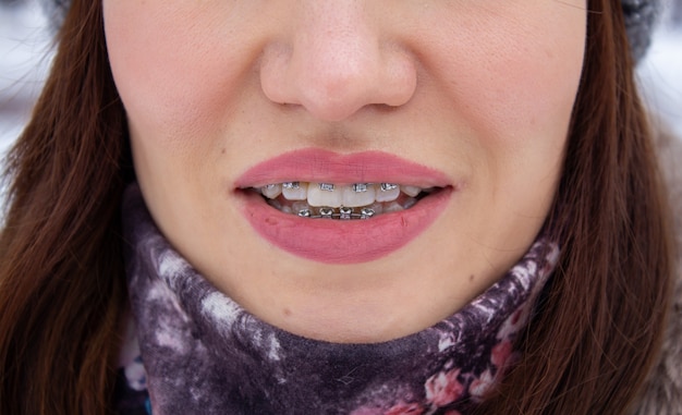 Sistema brasket na boca sorridente de uma garota, macrofotografia dos dentes. rosto grande e lábios pintados. aparelho nos dentes da menina