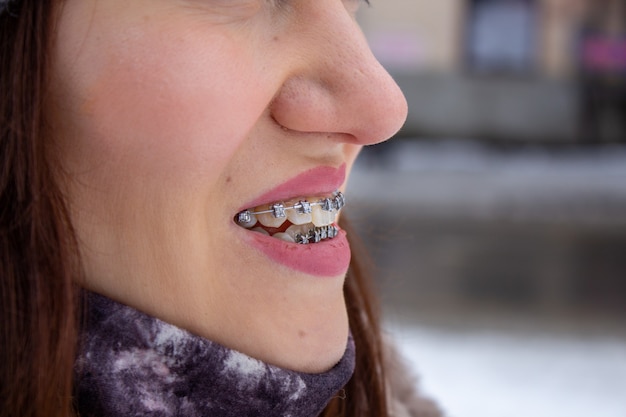 Sistema Brasket na boca sorridente de uma garota, macrofotografia dos dentes. rosto grande e lábios pintados