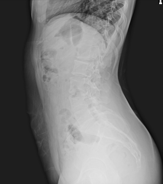 Skoliosefilm-Röntgenstrahl zeigen spinale Biegung im Jugendpatienten. Skoliose-Krankheit.