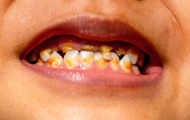 Sonriendo con caries dental en un niño, en los dientes frontales. Concepto de cuidado dental