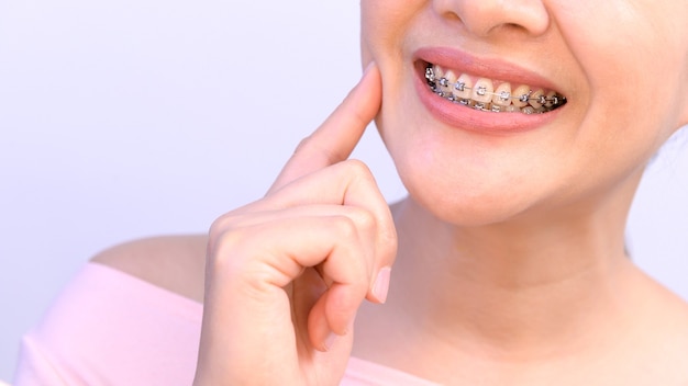 Sonriente mujer asiática con retenedor de ortodoncia. Cuidado dental y dientes sanos.