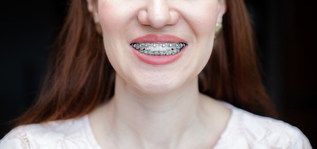 La sonrisa de una chica joven y hermosa con frenillos en sus dientes blancos. Enderezamiento de dientes torcidos con la ayuda de un sistema de brackets. Maloclusión. Cuidado dental. Dientes suaves y una hermosa sonrisa.