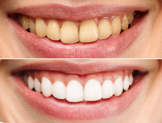 La sonrisa perfecta de los dientes sanos de una mujer para blanquear los dientes clínica dental imagen del paciente simboliza oral