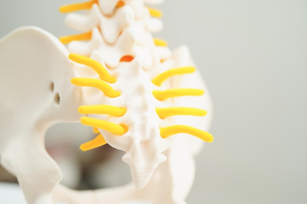 Spinalnerv und Knochen Lendenwirbelsäule verlagertes Bandscheibenfragment Modell für die medizinische Behandlung