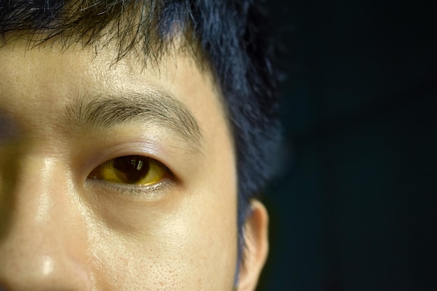 Starke Gelbsucht bei einem asiatischen männlichen Patienten Gelbliche Verfärbung von Haut und Sklera Hyperbilirubinämie