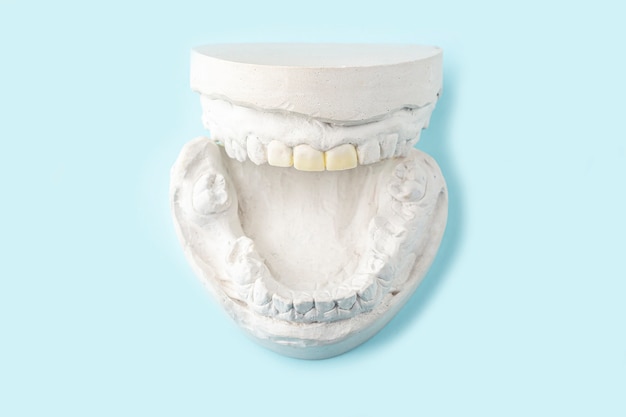 Stomatologischer Gipsabdruck, Formen menschlicher Kiefer und Zähne auf blauem Tisch. Zahngussgips zur Herstellung von Zahnersatz, Zahnspangen oder falschen Zähnen. Konzept für Zahnmedizin und Kieferorthopädie.