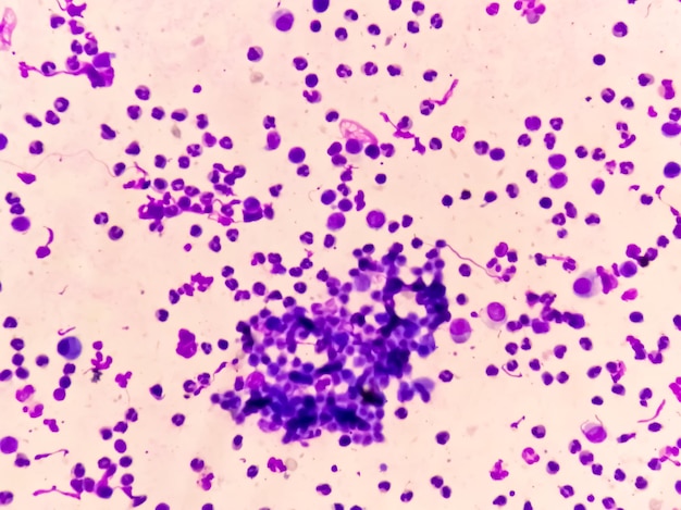 Synovialflüssigkeits-Zytologie, die viele WBC zeigt, um Arthritis zu diagnostizieren.