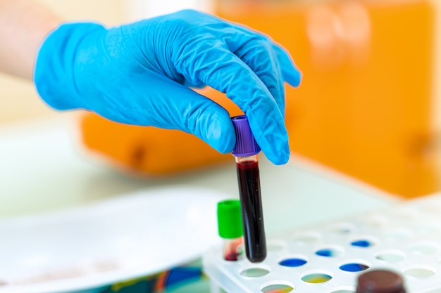 Foto técnico de laboratorio con muestra de tubo de sangre para estudio