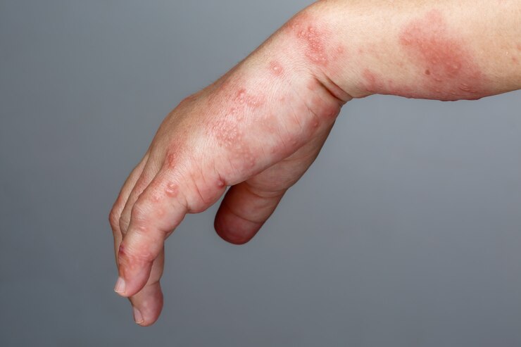 Foto telhas, sintomas de zoster ou herpes zoster no braço