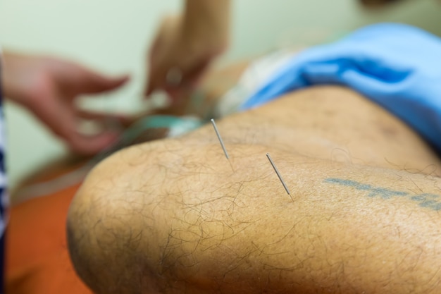 Terapeuta dando tratamento de acupuntura Para um idoso no hospital