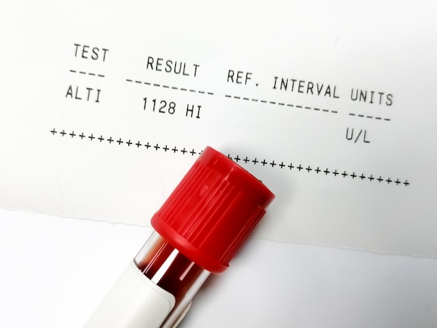 Teste ALT para teste de função hepática com relatório anormal do paciente