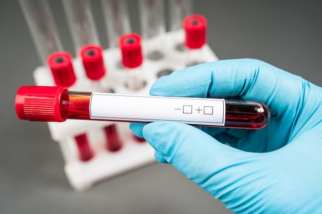 Teste de amostra de sangue e sangue do tubo vazio para triagem de exame de sangue com rótulo em branco para o seu texto em laboratório