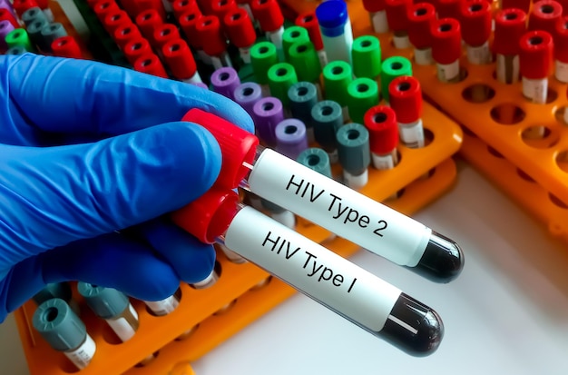 Teste de anticorpos HIV tipo 1 e HIV tipo 2 para diagnóstico de infecção por HIV