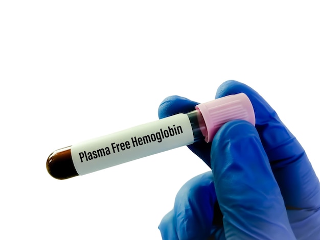 Foto teste de hemoglobina livre de plasma fhb para diagnosticar destruição de hemácias