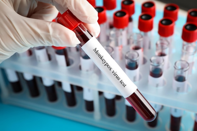 Teste de vírus Monkeypox Trabalhador de laboratório segurando tubo de amostra com sangue perto de rack closeup