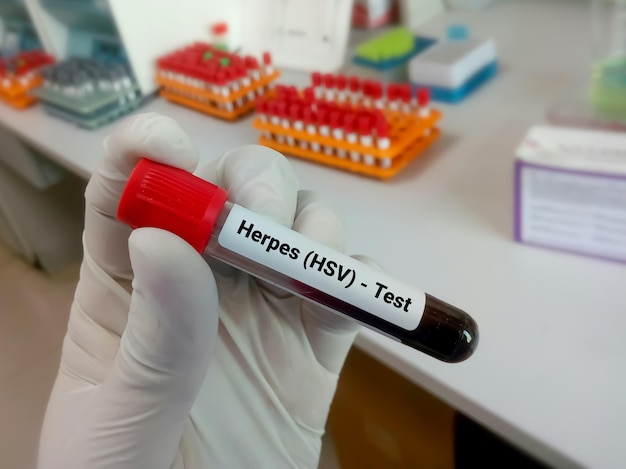 Teste do vírus herpes simplex