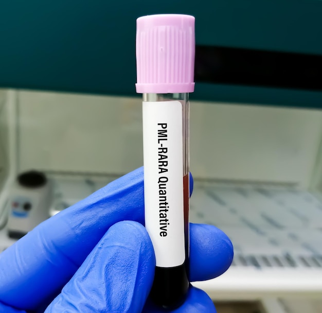 Teste quantitativo PMLRARA em laboratório de PCR para diagnosticar leucemia promielocítica