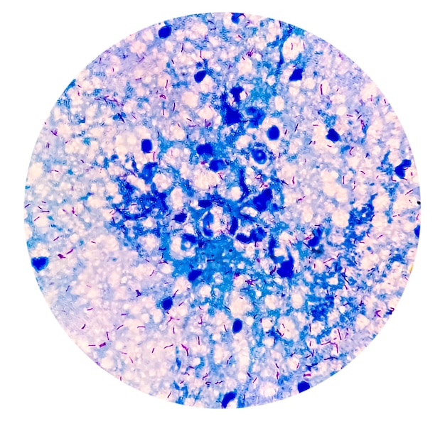 Tinción AFB. Microbacterium Tuberculosis Bacteria (MTB). Frotis de esputo o flema. Diagnóstico de MTB (TB).