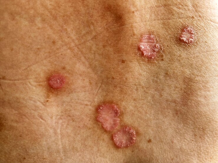 Foto tinea corporis em um dorso humano dermatophytosis