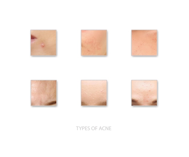 Foto tipos de acne