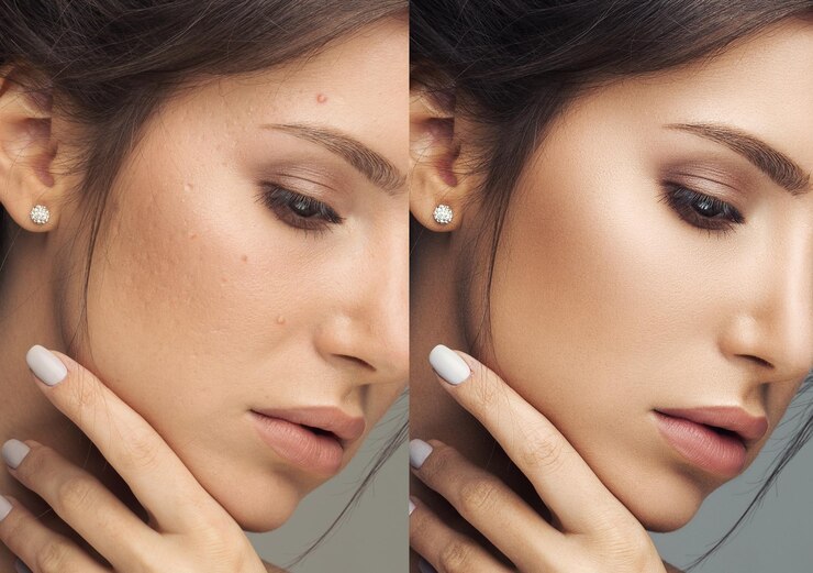 Foto tiro na cabeça de mulher bonita com pele perfeita e acne após esqui