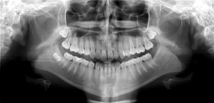 Foto tiro panorâmico do dente