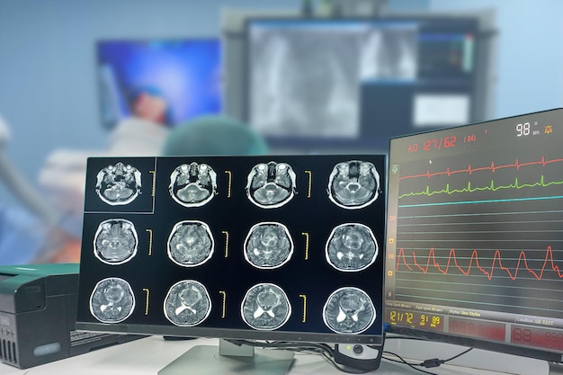 Foto tomografia computadorizada cerebral encontrando massa isodensa com margem mal definida e edema circundante no lobo frontal esquerdo metástase cerebral de glioblastoma fundo embaçado da sala de cirurgia