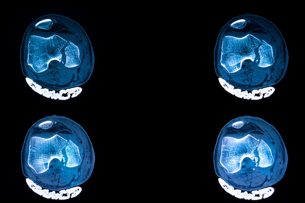 Tomografia computadorizada da fratura do planalto tibial do joelho direito de um paciente traumatizado