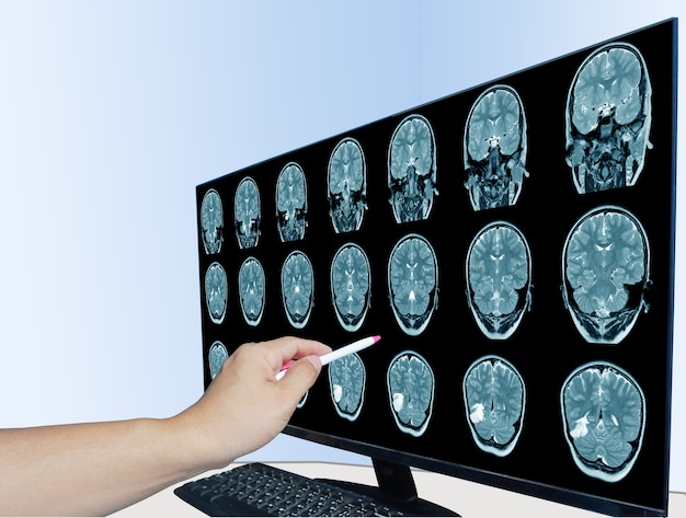 Tomografía computarizada del cerebro del Día mundial del accidente cerebrovascular Un hombre que sufre de dolor de cabeza pulsátil