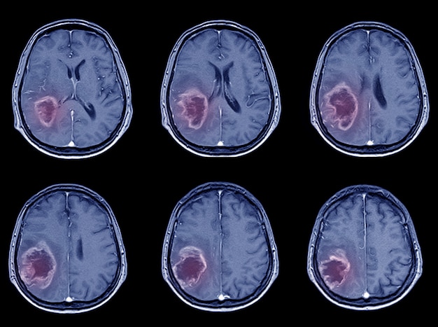 Foto tomografía computarizada de exploración por tomografía computarizada para el accidente cerebrovascular hemorrágico o accidente cerebrovascular isquémico.