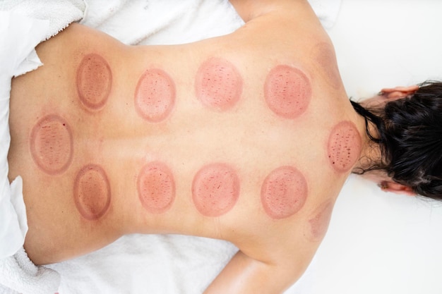 Top-Aufnahme von Hijama-Cupping-Marken auf dem Körper nach der Behandlung