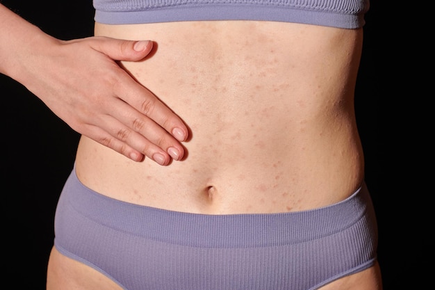 Torso femenino con erupción alérgica roja en la piel del estómago, dermatitis atópica, eccema, inflamación de la piel. Mujer joven aplicando ungüento médico en la piel con picazón con los dedos, tratamiento de fiebre