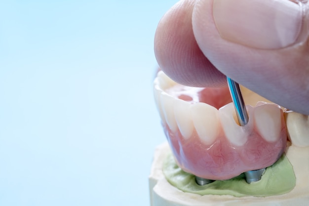 El trabajo del implante dental está terminado y listo para usar / pilar temporal del implante dental