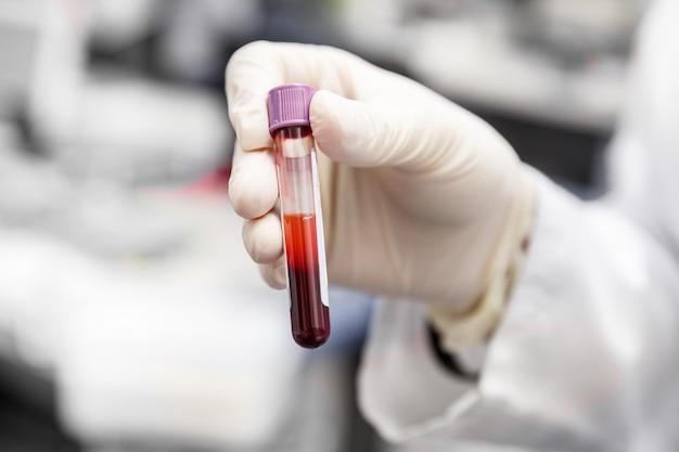 Trabalhadores médicos entregam uma luva de borracha segurando um tubo de laboratório com uma amostra de exame de sangue Conceito médico de saúde