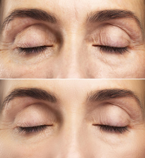 Foto tratamento anti-envelhecimento. comparação dos olhos femininos antes e depois do rejuvenescimento.