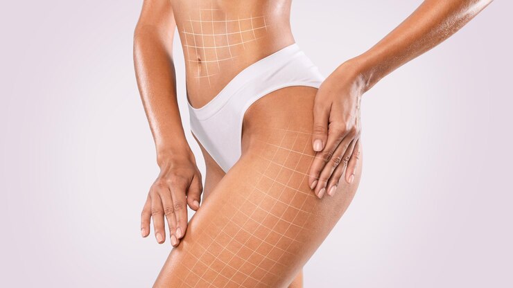Foto tratamento anticelulite levantando linhas desenhadas no corpo feminino perfeito em roupas íntimas